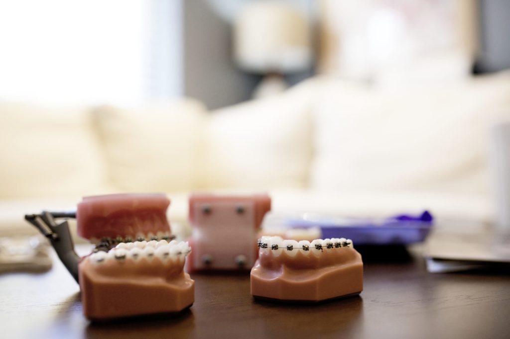 Metal braces model