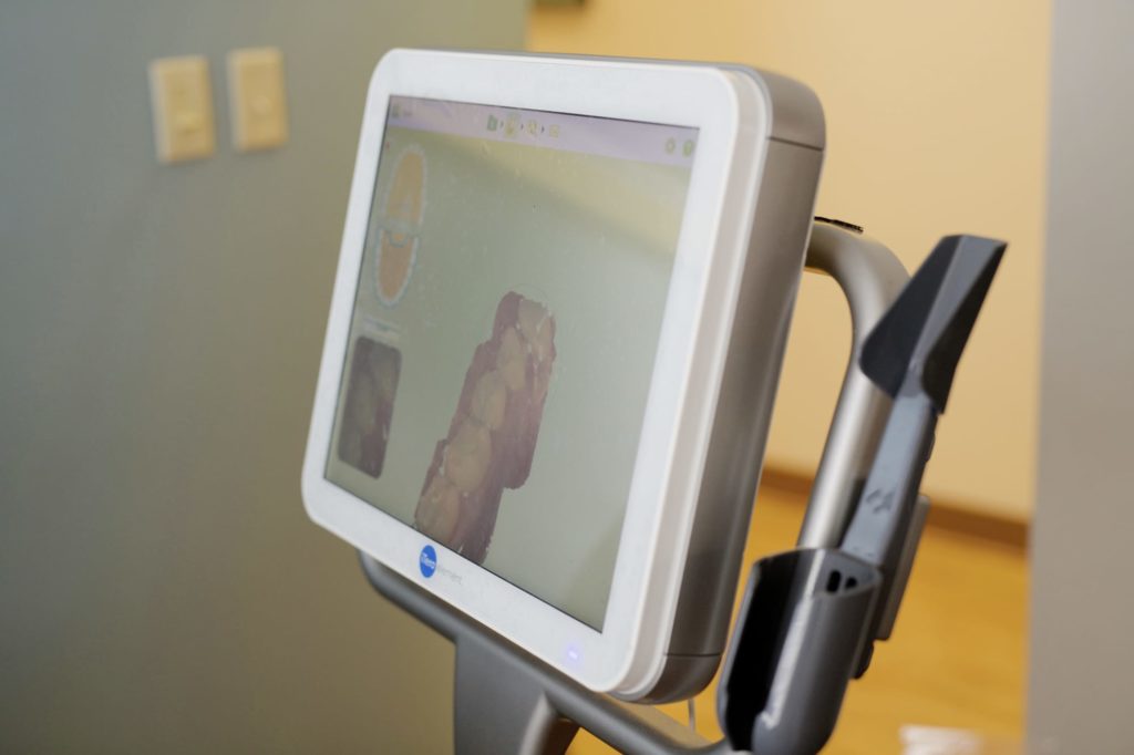 Itero digital scanner